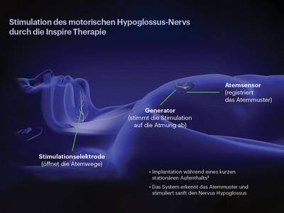 inspire system komponenten inspire medical systems